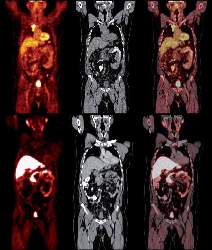 Srovnání PET/CT vyšetření pomocí [<sup>18</sup>F]FDG (horní řada) a [<sup>18</sup>F]fluorocholinu (spodní řada) – zleva PET sken, CT sken a fúze – u stejného pacienta s duplicitou tumoru ledviny a karcinomu prostaty. Mediastinální lymfatické uzliny vykazují vysokou akumulaci FDG, nejsou však aktivní na vyšetření [<sup>18</sup>F]fl uorocholinu, s vysokou pravděpodobností tedy souvisí s nádorem ledviny a nikoliv s karcinomem prostaty.