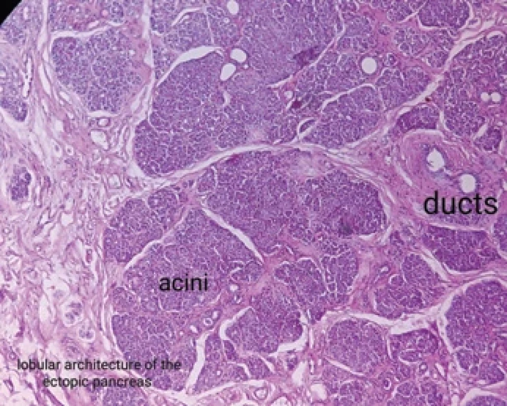 Medium-power view of the heterotopic pancreatic tissue showing the lobular architecture similar to pancreatic tissue.