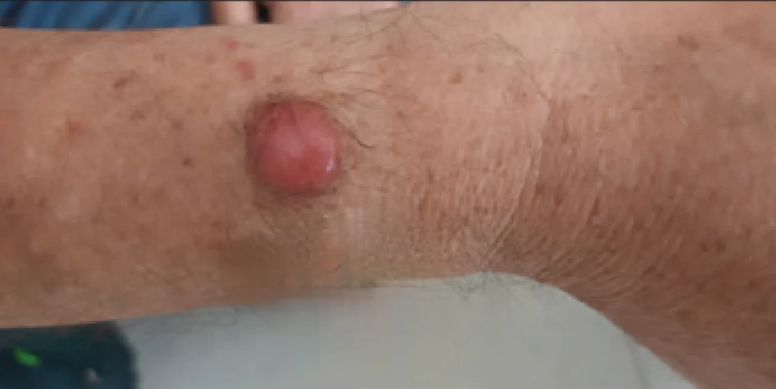 Karcinóm kože z Merkelových buniek (archív autorky).