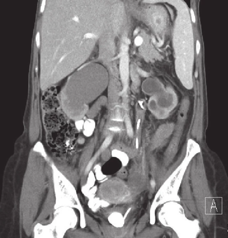 CT břicha (koronární řez po podání k.l., arteriální fáze) – inkrustovaný distální konec levého stentu; pokročilá hydronefróza oboustranně
Fig. 2. CT of abdomen (coronal section after aplication contrast fluid, arterial phase) – incrusted distal part of the left stent; advanced secondary megaureter bilateral