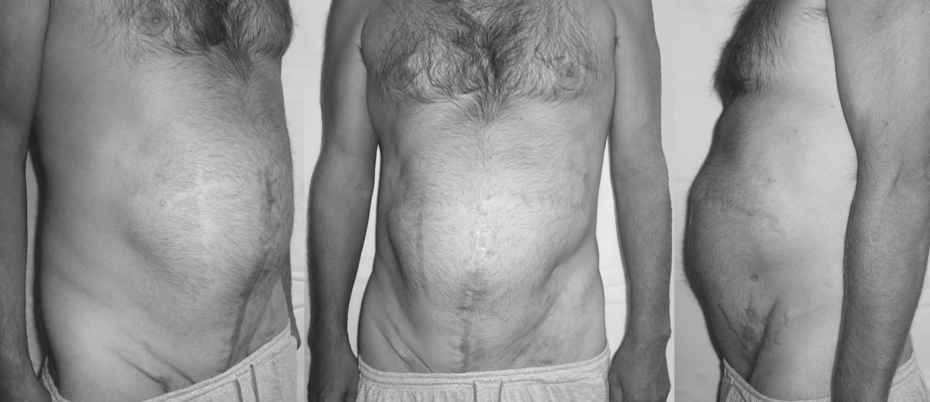 Fotografie – 2 měsíce po hernioplastice
Pic. 7. Photo – 2 months after hernioplasty