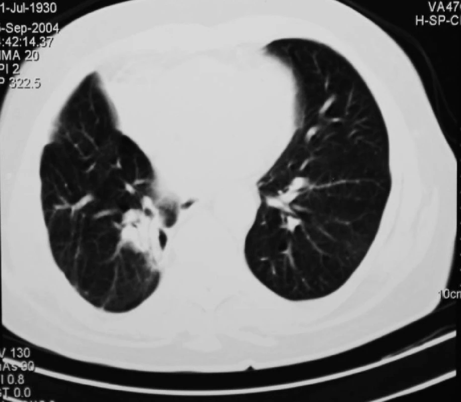 CT plic 3 měsíce po RFA ložiska v dolním plicním laloku vpravo
Fig. 4: Lung CT 3 months after RFA of the focus in the lower right lung lobe