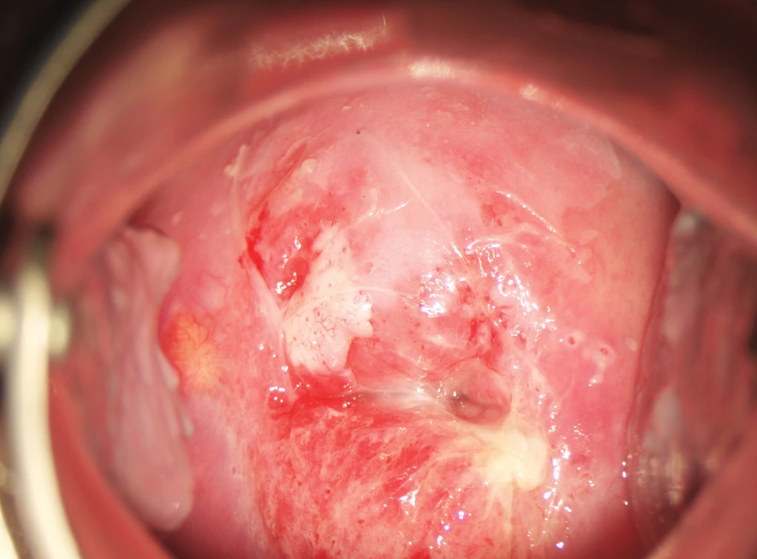 Kolposkopický nález po aplikaci 5% roztoku kyseliny octové u 30leté pacientky referované pro cytologický nález ASC-H. V široké atypické transformační zóně 1. typu je na předním pysku mezi č. 10–11 patrna vnitřní hranice, která ostře vymezuje oblast sytě bílého epitelu s hrubým puntíčkováním a hrubou mozaikou od periferně uložené oblasti méně sytého bílého epitelu. Biopticky verifikována CIN 3.