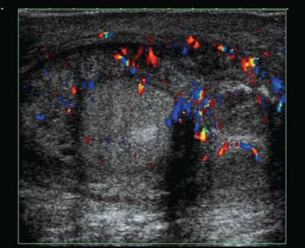 Incipientní absces nadvarlete.