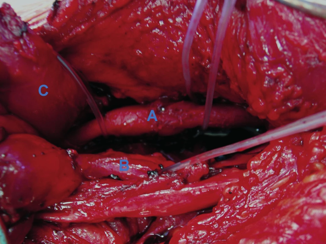 Peroperační nález
A – uzavřená podkolenní tepna s fibrotickou degenerací, B – popliteální žíla, C – resekovaný odstup mediální hlavy musculus gastrocnemius.
Fig. 2: Intraoperative finding
A – occluded popliteal artery with fibrotic degeneration, B – popliteal vein, C – medial head of the gastrocnemius muscle after myotomy.