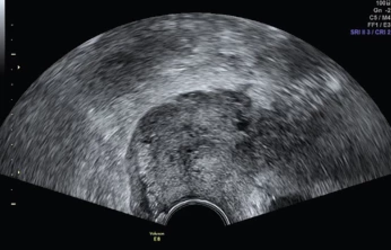 Reziduum pravého děložního hrdla. Fig. 3. Residue from the right cervix.