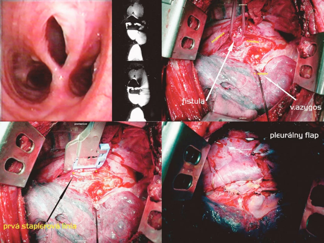 Staplerová separácia fistuly, pleurálny flap cestou pravostrannej torakotómie. Postup zľava doprava, zhora nadol: Tracheoskopický a CT obraz fistuly. Vypreparovaná fistula, prerušená v. azygos. Naloženie druhého pravouhlého staplera. Pleurálny flap vmedzerený medzi sutúry
Fig. 4. Stapler separation of the fistule, pleural flap via right-sided thoracotomy. Left to right and top to down: tracheoscopic and CT views of the fistule. A fistula isolated, the azygos vein divided. Application of another right angle stapler. A pleural flap is placed between the sutures