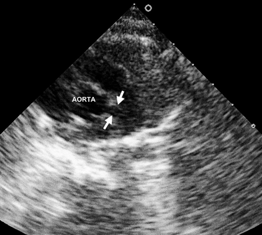 Fuziformní aneuryzma hlavního kmene levé koronární arterie.
Fig. 1. Fusiform aneurysms of the main stem of the left coronary artery.