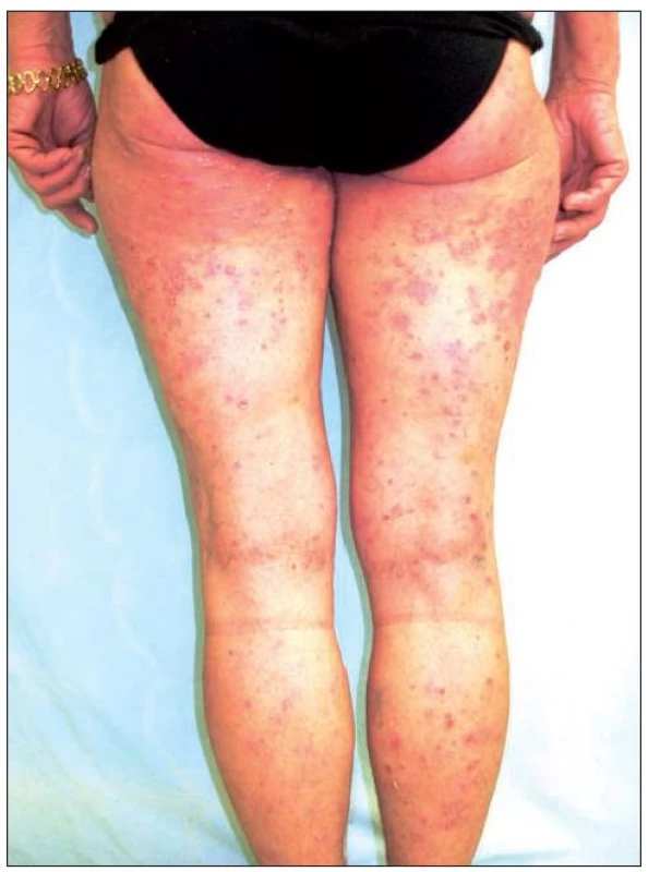 Obraz těžké formy chronické ložiskové psoriázy – stav před zahájením terapie etanerceptem