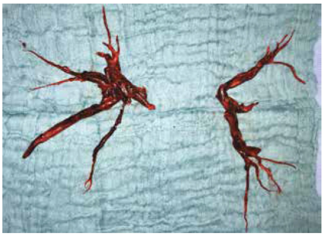 Embolus odstraněný z levé a pravé větve plicnice<br>
Fig. 3: Emboli extracted from the left and right pulmonary
artery
