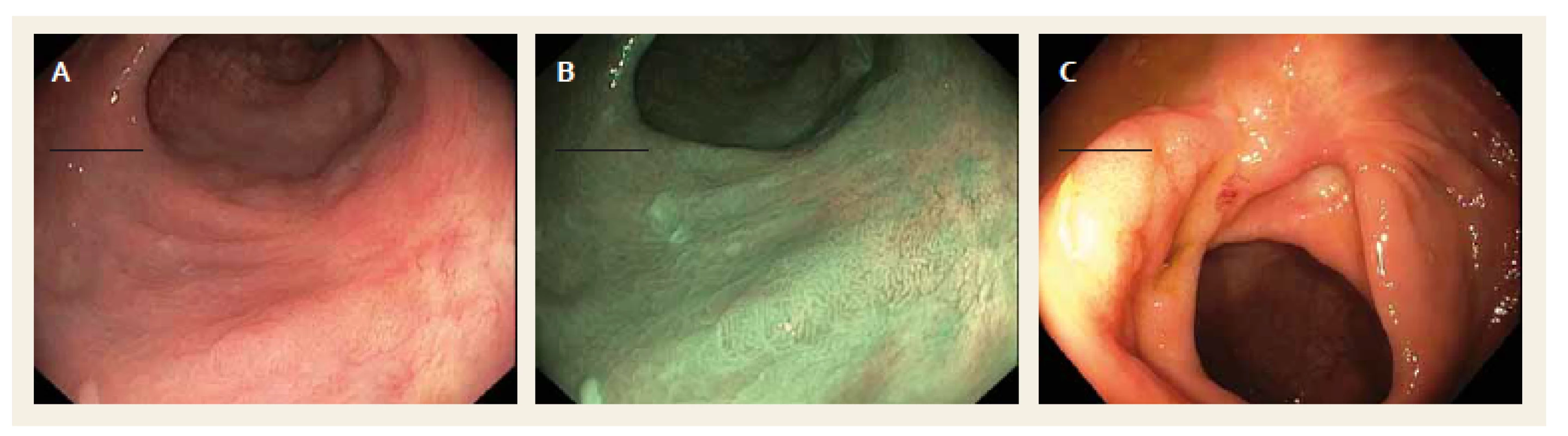 Lokální reziduální neoplazie – A. ≤ 5 mm, bílé světlo; B. ≤ 5 mm, narrow-band imaging; C. ≥ 5 mm.
Fig. 1. Local residual neoplasia – A. ≤ 5 mm, white light; B. ≤ 5 mm, narrow-band imaging; C. ≥ 5 mm.