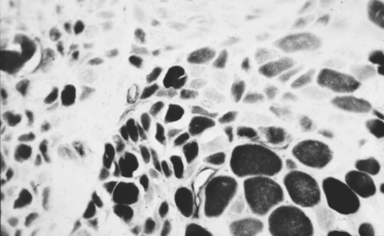 Biopsie z krikofaryngeálního svalu ukazuje atrofii obou typů vláken a typické perifascikulární uspořádání atrofie (ATPáza, pH 10,4; 200x).