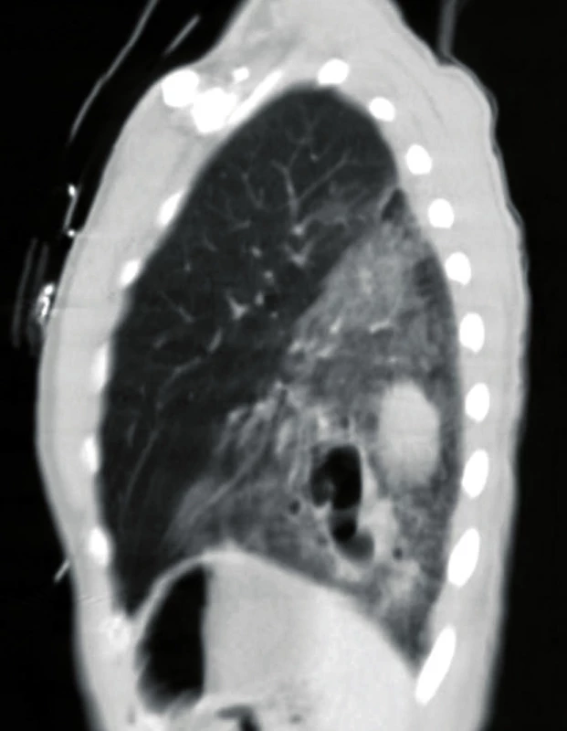 Sagital CT