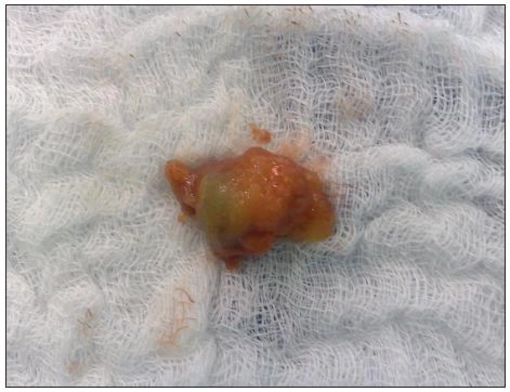 Sfarbená „Hot spot“ uzlina
Fig. 5. Stained „Hot spot“ lymph node