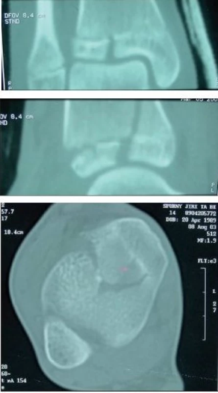 CT hlezna po 1,5mm s 2D rekonstrukcemi 
a) rekonstrukce ve frontální rovině s lomnou linií epifýzy.
b) rekonstrukce v sagitální rovině s lomnou linií procházející epifýzou a metafýzou, separace růstové štěrbiny.
c) transverzální CT scan v úrovni epifýzy.
