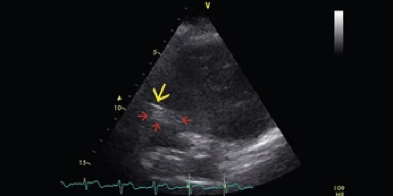 Echokardiografi cká kontrola patentnosti ventrikuloatriálního shuntu.<br>Fig. 4. Echocardiographic exam of the patency of the ventriculoatrial shunt.