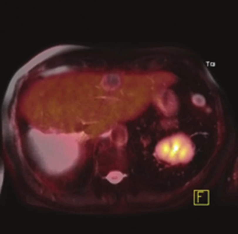 PET/MR obraz jater po RFA – bez známek recidivy v oblasti zbytkového parenchymu (axiální řez)
Fig. 5: PET/MRI hybrid scan after RFA – no signs of recurrence in the residual parenchyma of the liver (axial view)