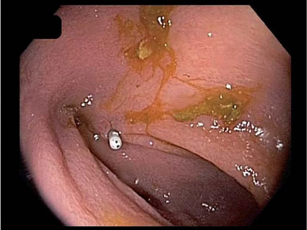 Ústí píštěle v tračníku označené klipem.
Fig. 3. The orifice of the fistula in the colon marked by a hemoclip.