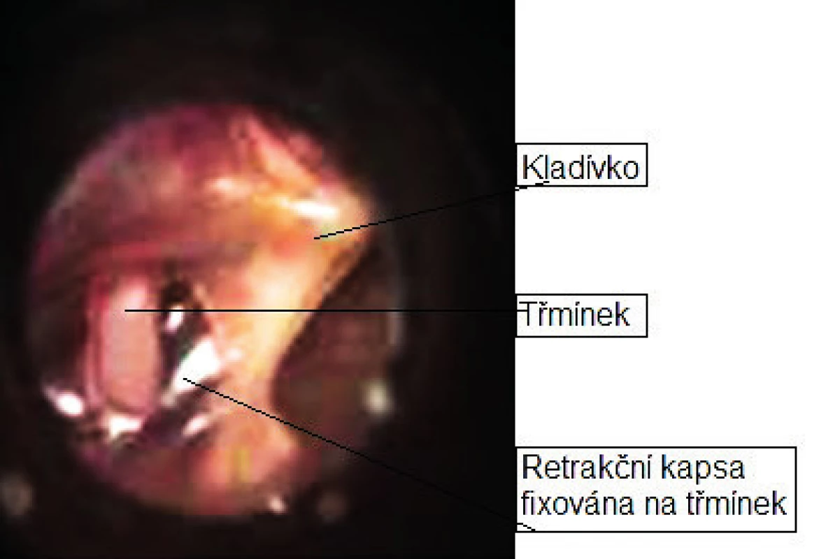 Obr. 5. Retrakční kapsa ušního bubínku.
Fig. 5. Retraction pocket of the tympanic membrane.