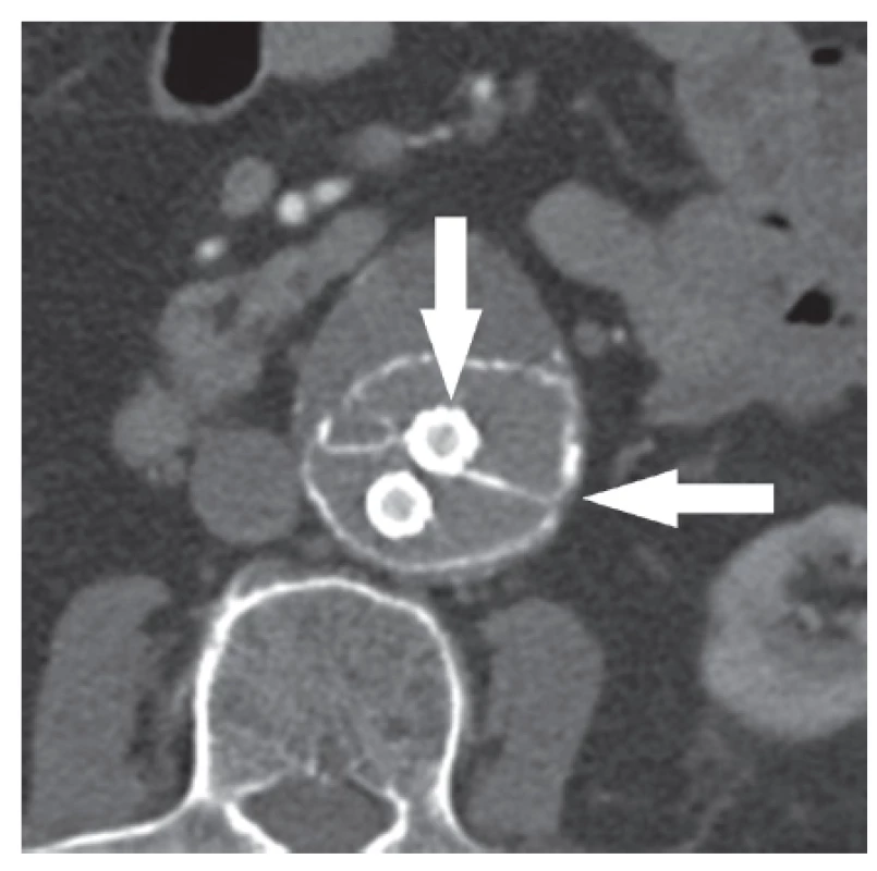 Příčný řez výdutí s implantovaným systémem Nellix
Fig. 2: Cross-section of the aneurysm with implanted Nellix system

