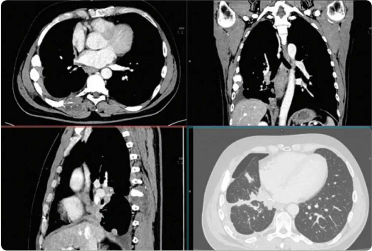 První série snímků PET/CT vyšetření – obraz po 4 měsících léčby pemigatinibem, je patrná vysoká metabolická aktivita nádorových infi ltrátů na pleuře a částečná regrese a sklerotizace kostních metastáz. 