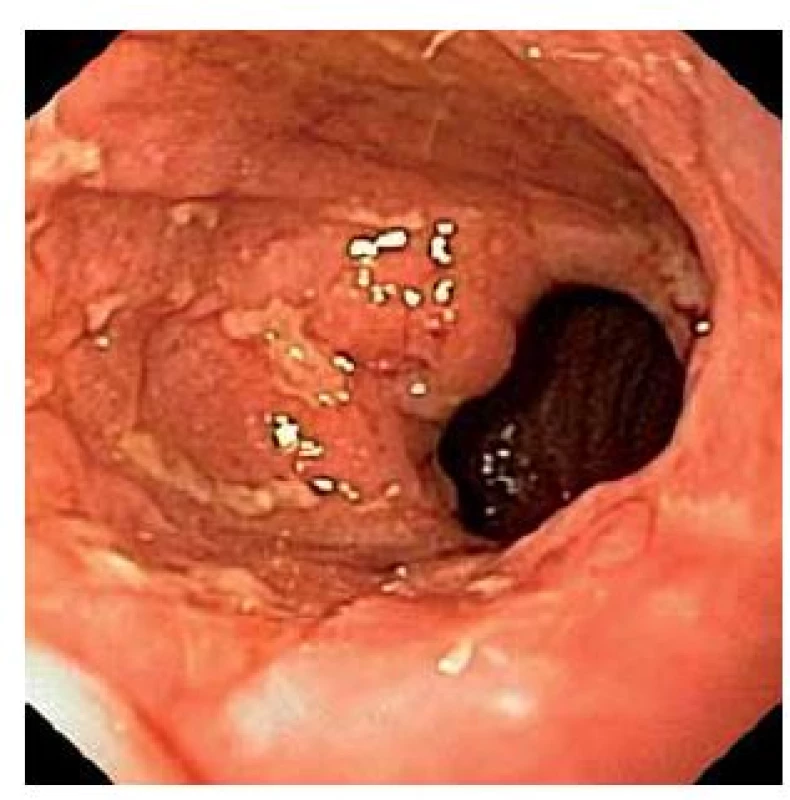 Zánět sliznice ponechané části anorekta (cuffu) pod pouchem (cuffitida).
Fig. 3. Inflammation of remnant anorectal cuff under pouch (cuffitis).