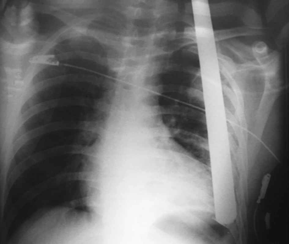 RTG hrudníku u zraněného s penetrujícím poraněním vzniklé pádem na hromosvod
Fig. 3. Thoracic x-ray in a patient with penetrating trauma caused by a fall on a lightning conductor