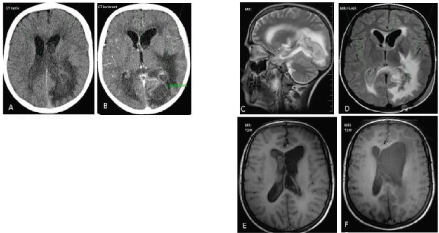 Vývoj CT a MRI nálezu u pacienta č. 3.
A–B. CT natív – patologický obsah v mozgových komorách, prevalenie abscesu do komôr, perifokálny edém, absces s priemerom 25,8 mm – temporo-occipitálne vľavo.
C. Rozšírenie ľavej bočnej komory so septami po ventrikulitíde.
D. Stav po opakovaných punkciách abscesu. Pretrváva patologický obsah v komorách, zmenšenie abscesovej dutiny.
Fig. 3. The changes of CT and MRI in a case 3.
A–B. CT native scan – a pathologic content within the ventricles of brain (pus), a perifocal edema, an abscess in diameter 25.8 mm in the left temporo-occipital area.
C. Dilatation of the left ventricle with the septs.
D. The lesion after repeated punctures of abscess. A pathological content (pus) persists.