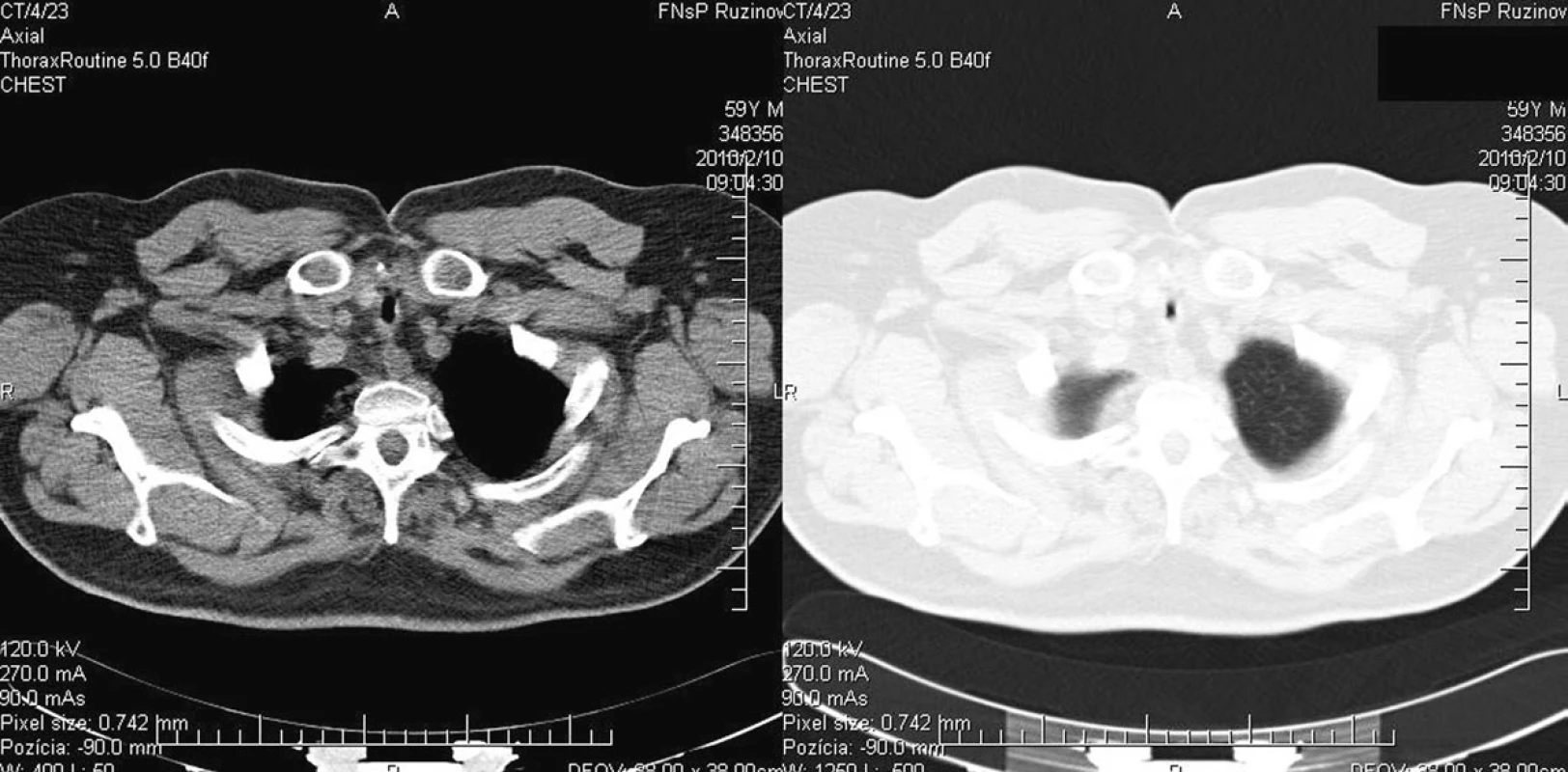 Stav pred reresekciou (pacient č. 5)
Fig. 5. The patient‘s condition prior to the re-resection procedure (patient No 5)