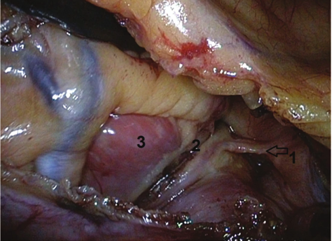 Torakoskopický pohled zleva do perikardu: 1) Marshallovo ligamentum, 2) ablační léze, 3) baze ouška levé síně
Fig. 5: Pericardium, left thoracoscopic view: 1) ligament of Marshall, 2) ablation lesion, 3) basis of the left atrial appendage