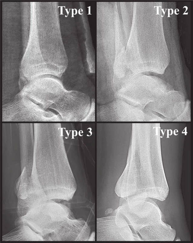 Anatomická 3D CT klasifikace z r. 2015 [34]
Jednotlivé typy na rtg bočných snímcích.
Fig. 7: Anatomical 3D CT classification published in 2015 [34]
Individual types on lateral radiographs.