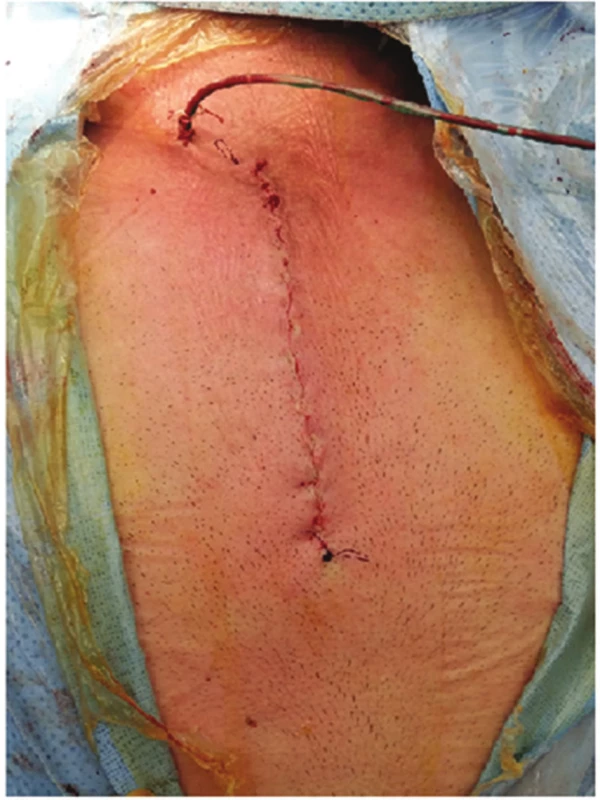 Parciální sternotomie
Fig. 2: Partial sternotomy