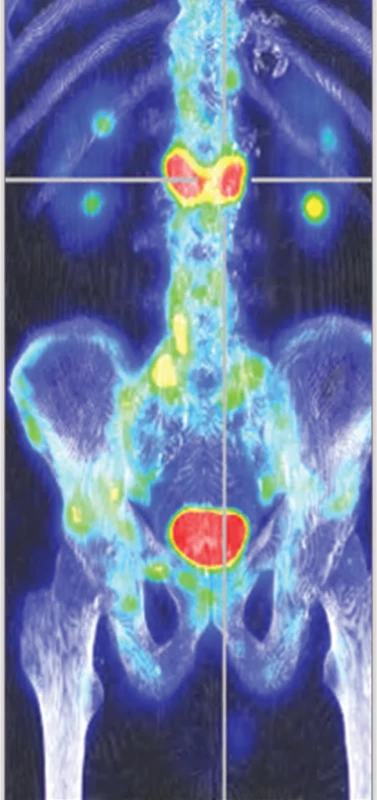 Fúze SPECT/CT pozdní fáze v MIP – zvýšená akumulace RF v obratlovém těla L2 a méně pak v obratlovém těle L4.