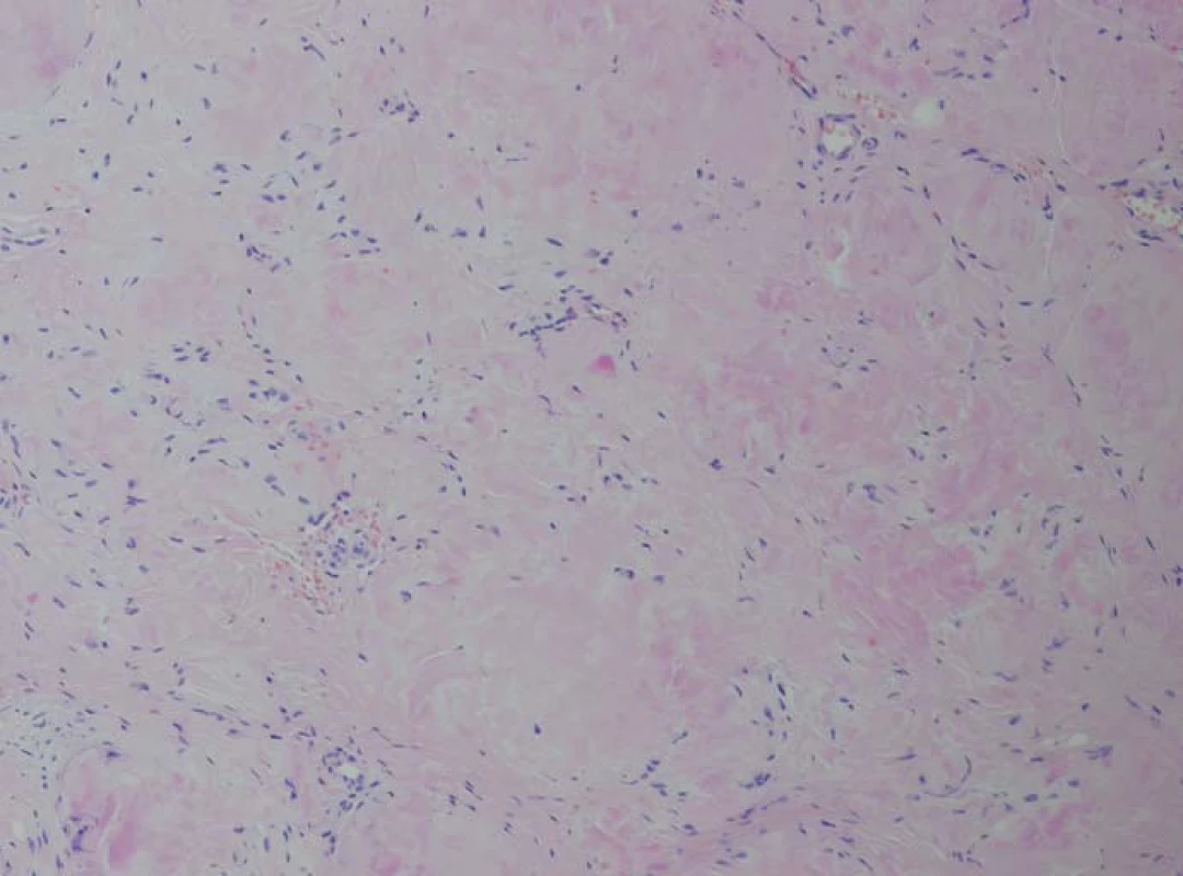 Barvení HE (hematoxylin-eozin) – světle eozinofilní hmoty – depozita amyloidu.