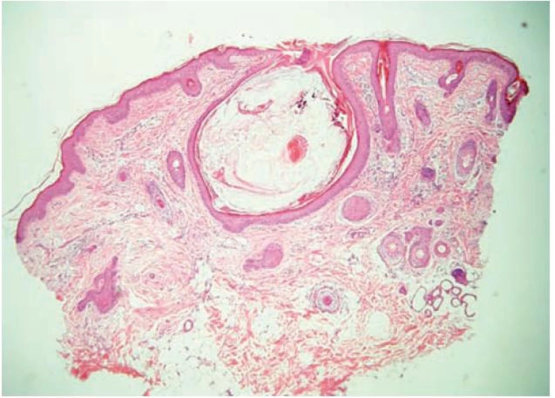 Histologický nález
Rozšířené infundibulum vlasového folikulu s hyperkeratotickým čepem a v něm stočeným velusovým vlasem (HE 40x).