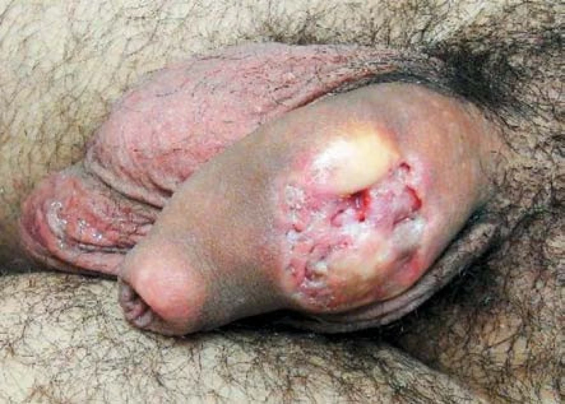 Vředovitý hypertrofický defekt na dorzu penisu vzniklý s latencí několika let po lokální injekční aplikaci borové masti do podkoží
Fig. 1. Ulcerative hypertrophic defect on the dorsum of the penis developed some years after the local injection application of boric ointment into the subctaneous tissue