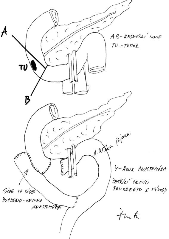 Vytnutí stěny dvanáctníku s nádorem, částečný uzávěr duodena a antemezenterická Y-Roux duodenojejunální anastomóza
Fig. 7: Simple resection of the duodenal wall with the tumour, suture of duodenum and Y-Roux ante-mesenteric duodenojejunal anastomosis