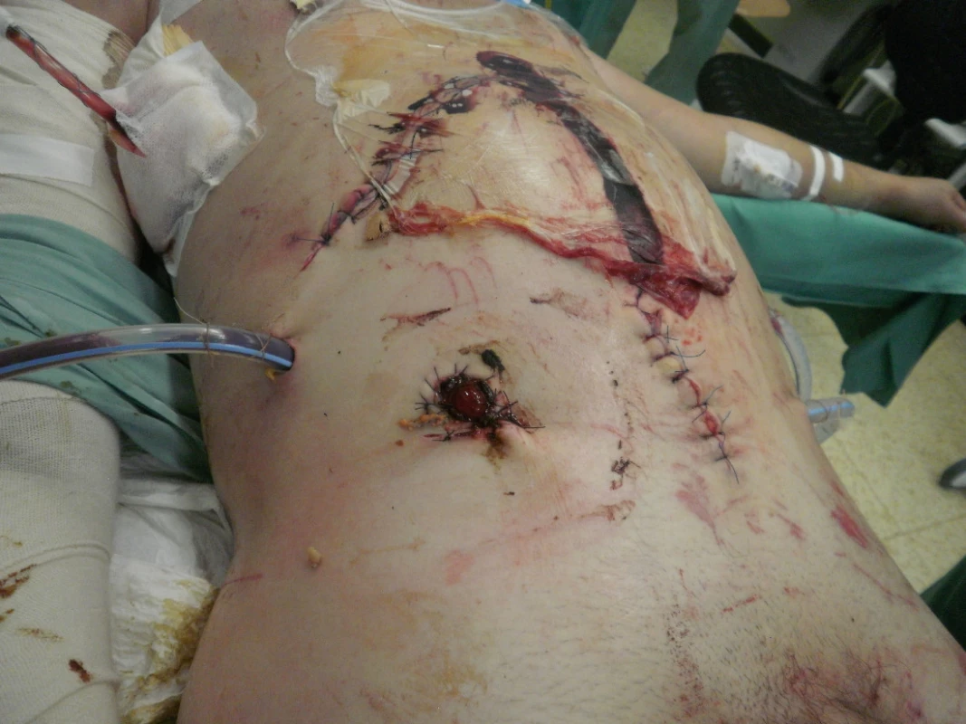 Pooperační snímek zraněného s laparostomií a ileostomii po damage control laparotomii (mechanismus úrazu - pád z výše)