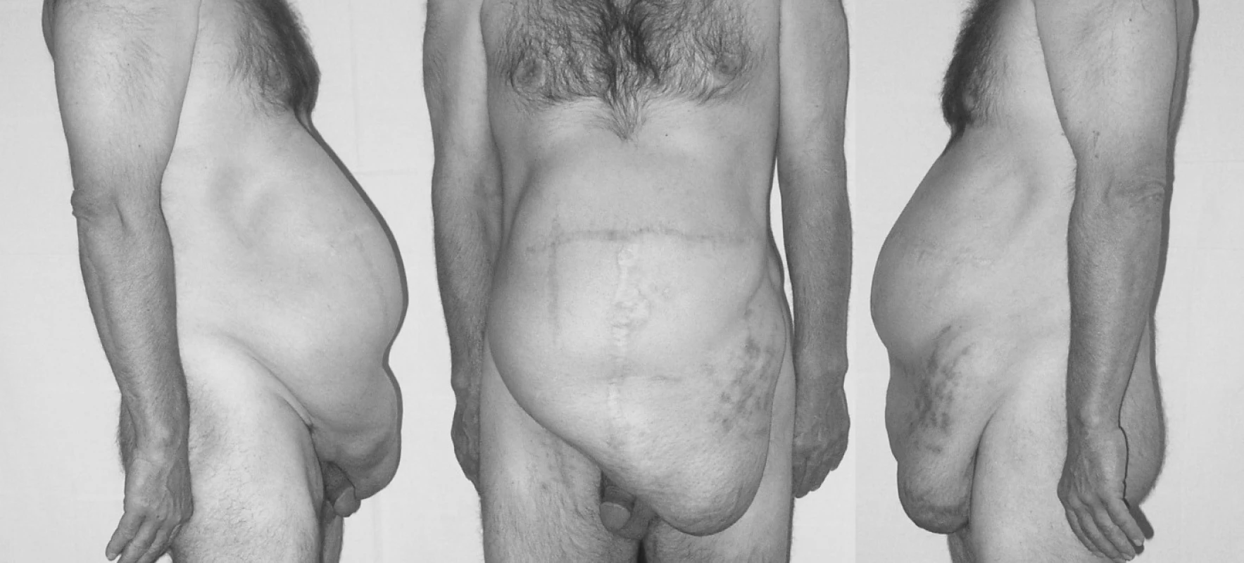 Osmá recidiva incizionální kýly – předoperační fotografie
Pic. 4. Eighth recurrence of incisional hernia – preoperative photo