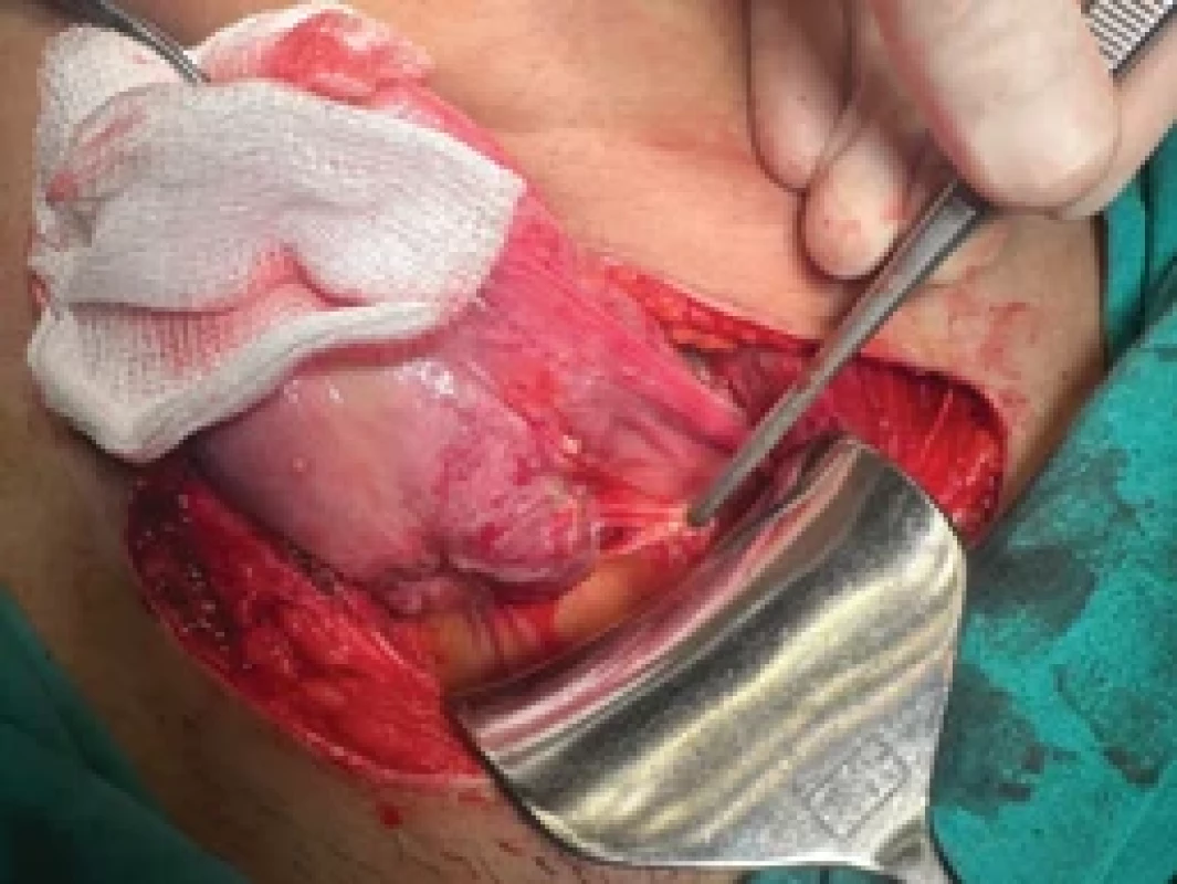 Intraoperative view of the AVM of the uterine (bladder dissection). Obr. 2. Intraoperační pohled na AVM dělohy (disekce močového měchýře).