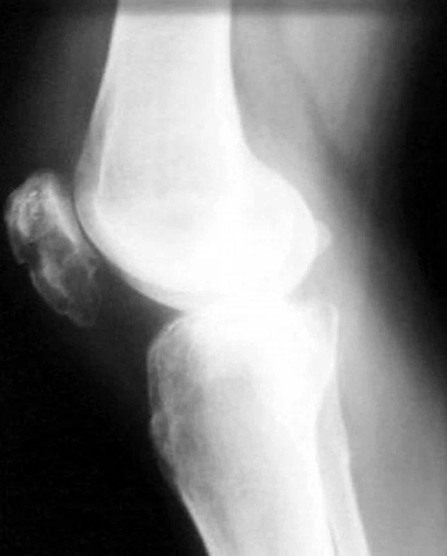 RTG snímky po odstranění osteosyntetického materiálu
