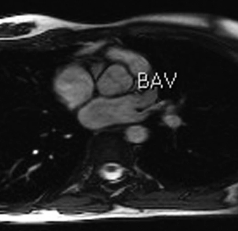 MRI aortální chlopně – funkčně bikuspidální aortální chlopeň u pacientky s TS – neúplná separace pravého a levého koronárního cípu (archiv autorů).
Fig. 5. MRI of aortic valve – functional bicuspid aortic valve in a female patient with TS – incomplete separation of the right and left coronary tip (authors’ archive).