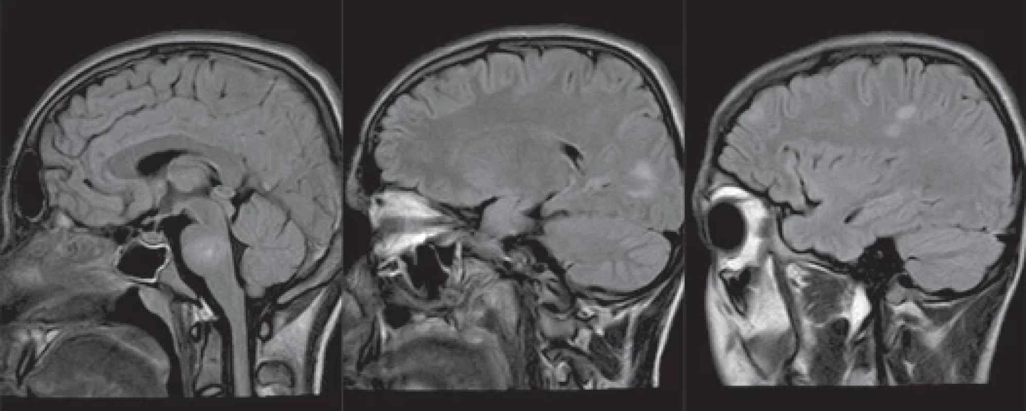 MR mozku s nálezem demyelinizačních lézí supra- a infratentoriálně – prosinec 2022 (sekvence FLAIR).</br>Fig. 5. MRI of the brain with fi ndings of demyelinating lesions supra- and infratentorially – December 2022 (FLAIR sequence).