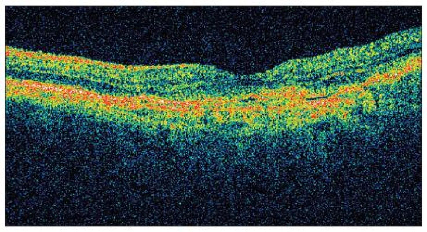 OCT OS září 2009 tlouštka neuroretiny ve fovee: 150 μm