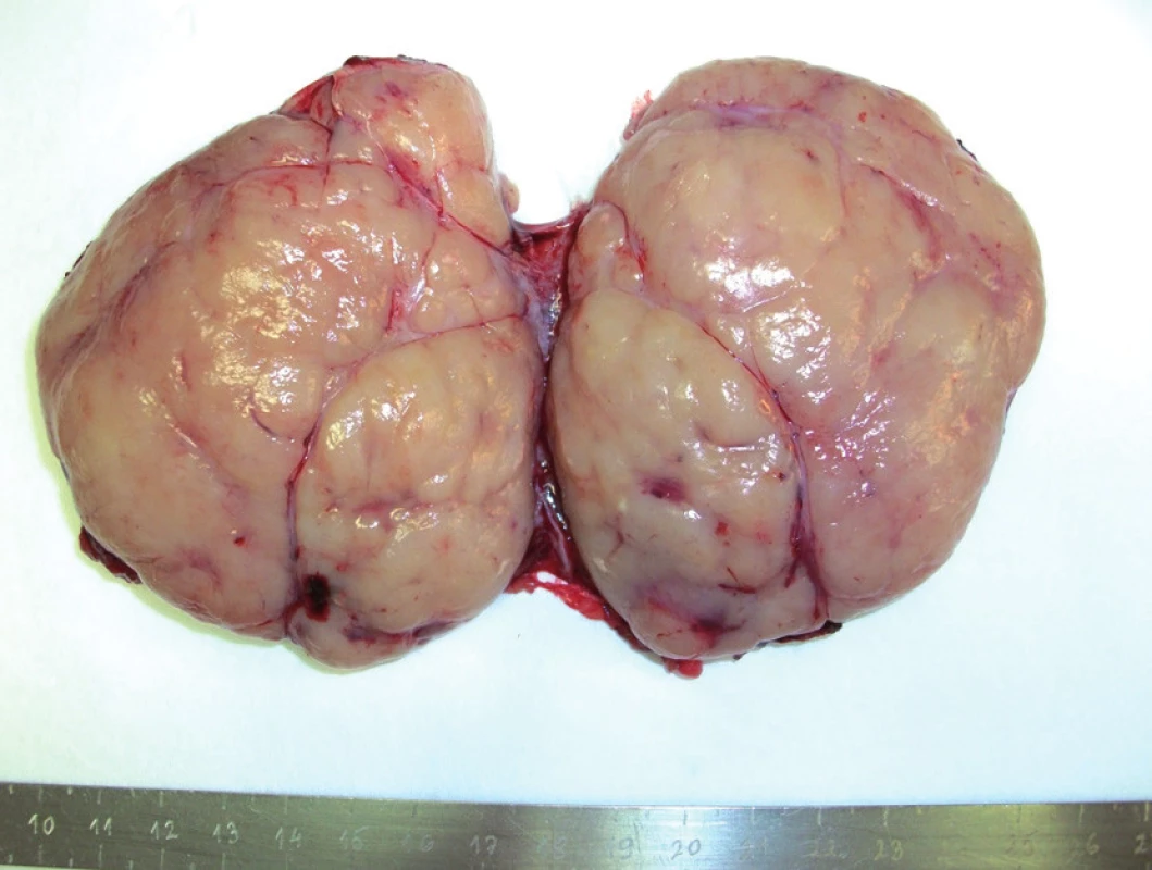 Makroskopický obraz nádorovej lézie z retroperitonea. Išlo o útvar na povrchu opúzdrený, na reze multinodulárneho solídneho vzhľadu a sivobielej farby.
Fig. 3. Macroscopic image of the retroperitoneal tumour. It was an encapsulated mass with multinodular solid appearance and grey-white colour on cut surface.