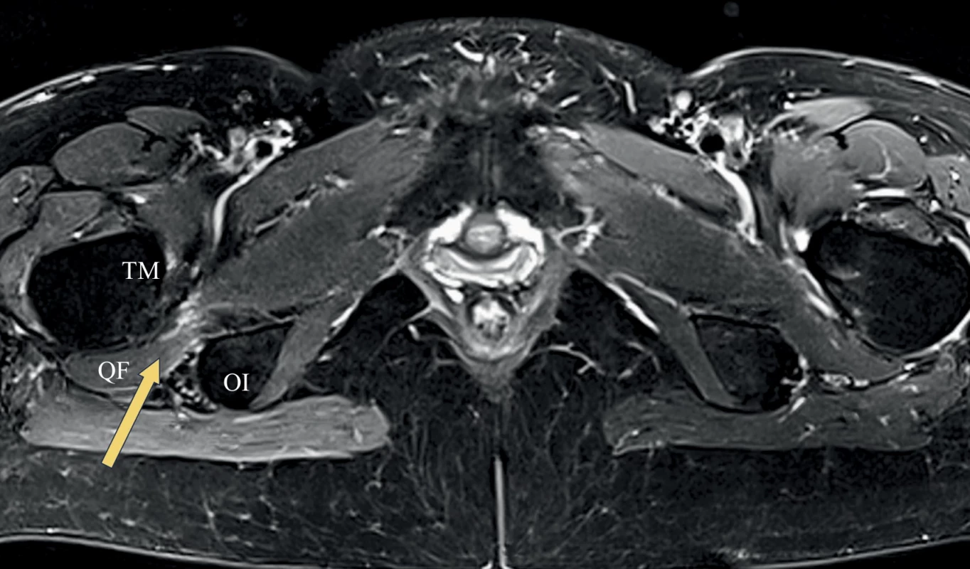 Axiální T2 vážené zobrazení pánve – jednostranný ischiofemorální impingement (šipka) s tukovou přestavbou  m. quadratus femoris (QF) mezi os ischii (OI) a trochanter minor (TM) na symptomatické straně pacienta (zdroj: vlastní  soubor pacientů). Fig. 3. Axial T2-weighted image of the pelvis – unilateral ischiofemoral impingement (arrow) with fatty degeneration of the  quadratus femoris muscle (QF) between the os ischii (OI) and lesser trochanter (TM) on the symptomatic side of the patient  (source: author’s own patient cohort).