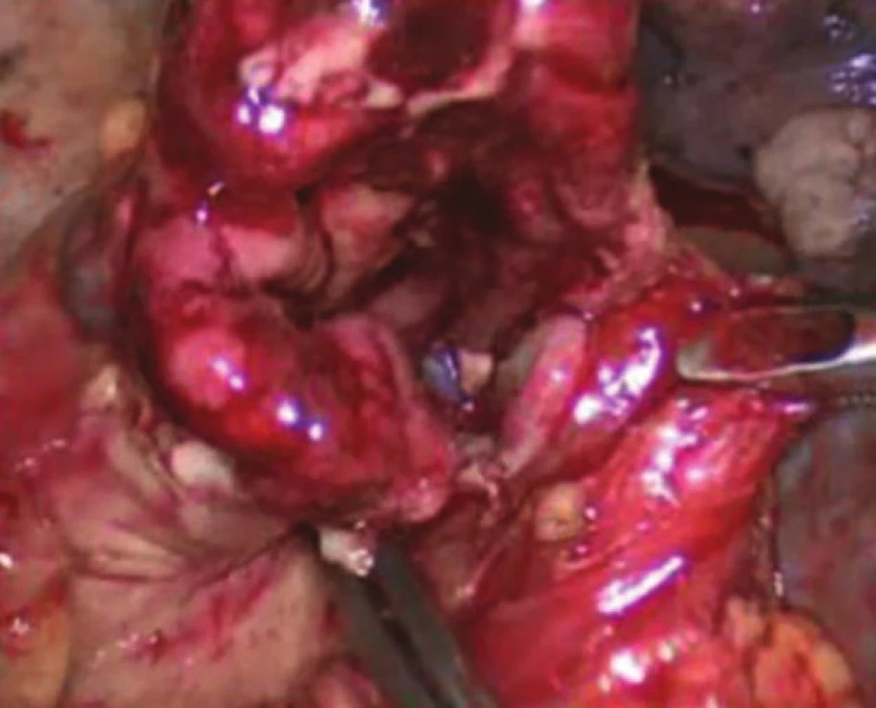Intrathorakální anastomóza
Fig. 1: Intrathoracic anastomosis