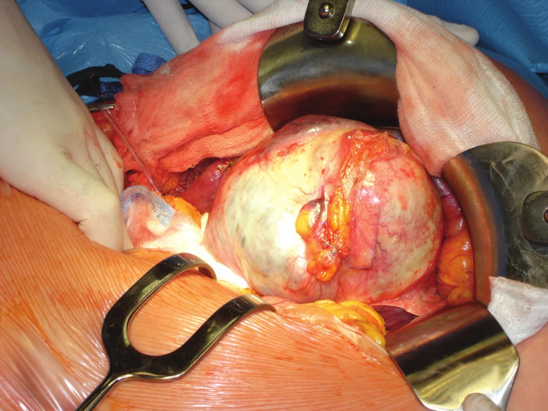 Peroperační snímek při resekci cystdenomu u případu 3 
Photo 2. Cystadenoma resection peroperative view – case No. 3