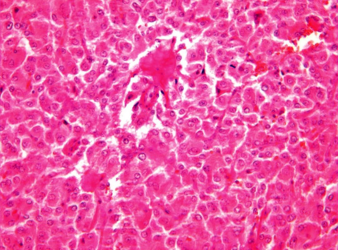 Histologická struktura extraadrenálního paragangliomu, barvení hematoxylin-eosin, zvětšení 200x
Fig. 3. Histological structure of the extraadrenal paraganglioma, hematoxylin-eosine staining (HE), enlargement 200x