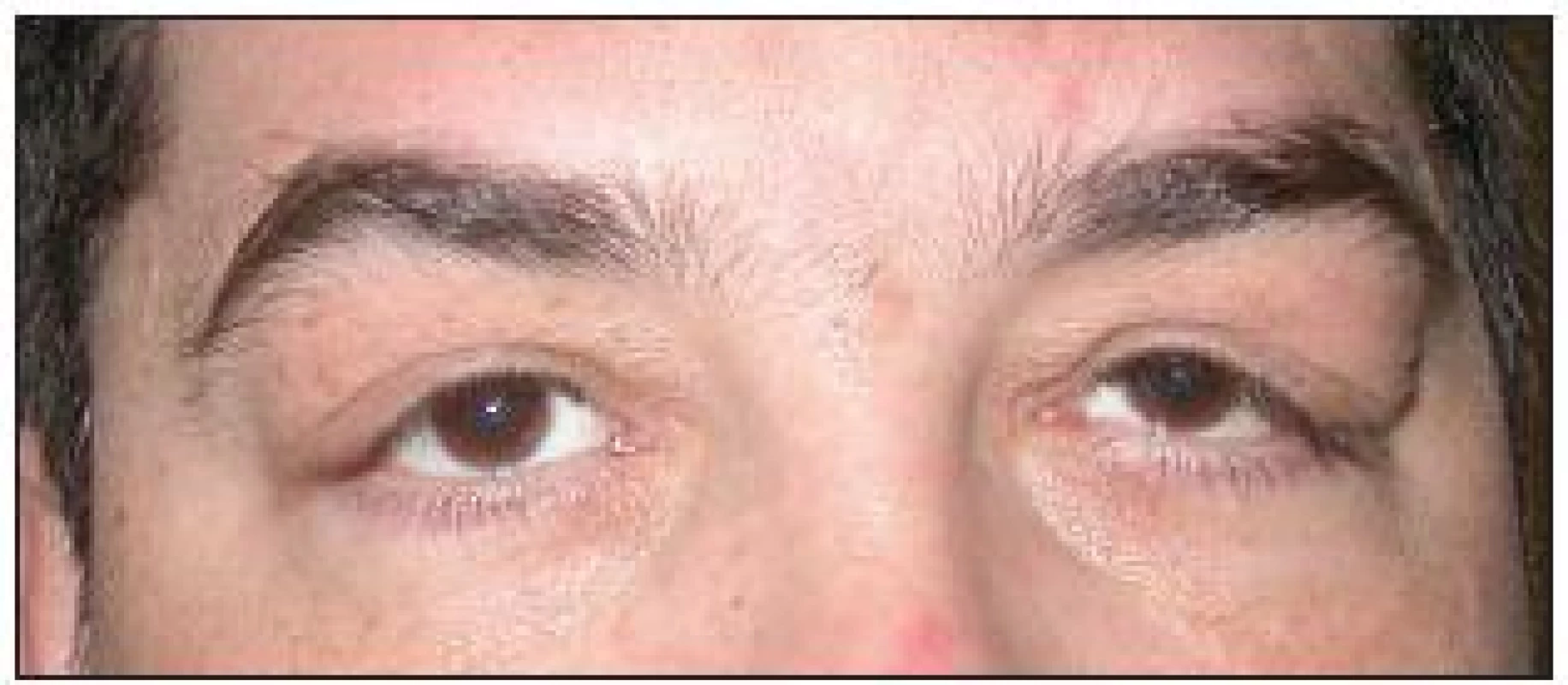 Výrazná dermatochaláza až esovité prohnutí víček u pacienta s těžkým FES a OSA, nález je více akcentován vlevo